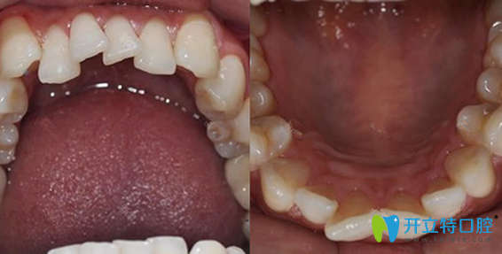 牙齒錯(cuò)亂在惠州致美口腔做了隱性矯正,三個(gè)月效果就很明顯