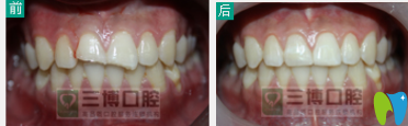 石家莊三博口腔補(bǔ)牙案例