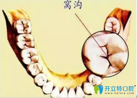 石家莊三博口腔李磊做客FM98.1廣播電臺解說窩溝封閉