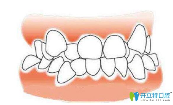 牙齒擁擠怎么矯正？一定要拔牙才能矯正嗎？