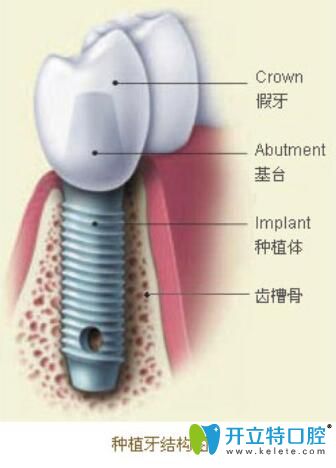 低價(jià)位的種植牙要警惕！
