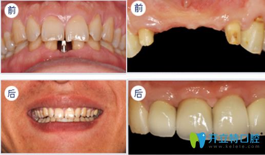 深圳拜博口腔黎強(qiáng)醫(yī)生牙齒種植經(jīng)典案例