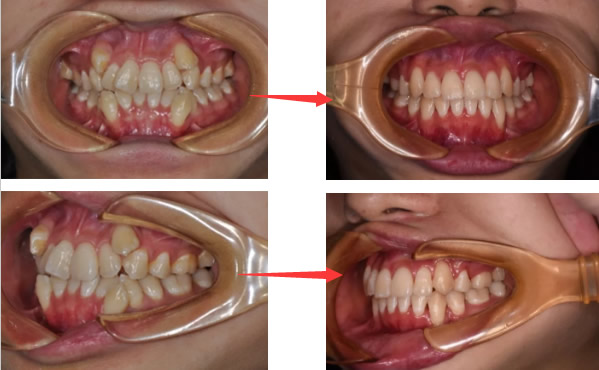 30多歲還能矯正牙齒嗎要多久 看我在鄭州拜博口腔正畸過(guò)程