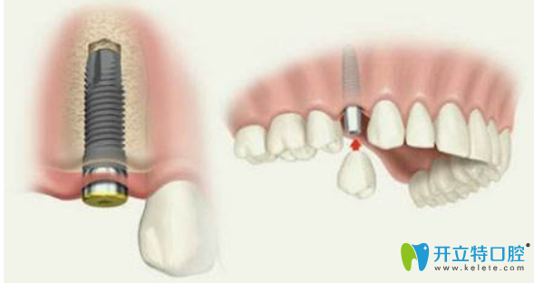 種植牙分為三個(gè)步驟
