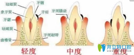 牙齦萎縮怎么辦該怎樣治療?萎縮的牙齦還能長(zhǎng)回來(lái)嗎