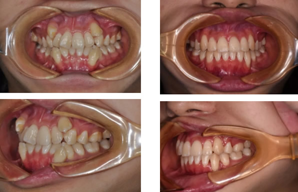 青島拜博口腔郁章欣醫(yī)生的正畸案例 牙齒不齊的寶寶看一下