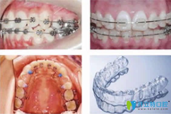 北京壹加壹口腔醫(yī)生介紹牙齒稀疏牙縫大的矯正方法圖