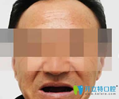 無錫通善口腔怎么樣 王杏松院長即刻種植牙案例及效果反饋