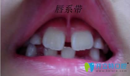 上唇系帶修整術(shù)是什么？唇系帶斷了修復(fù)時(shí)間是何時(shí)