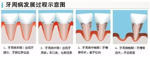 整牙會(huì)導(dǎo)致牙齦萎縮嗎？整牙后牙齦萎縮怎么辦？