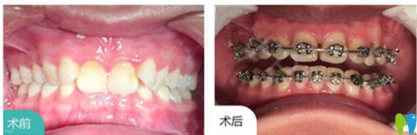 吉林愛齒口腔耿悅牙齒矯正對比圖