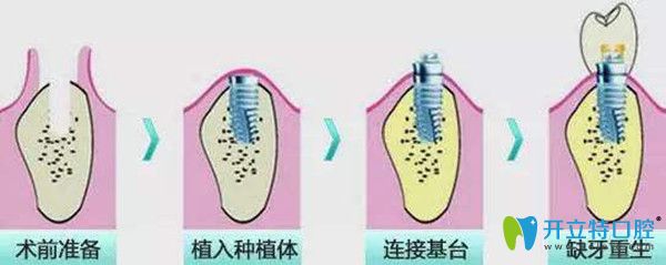 種植牙種植流程圖