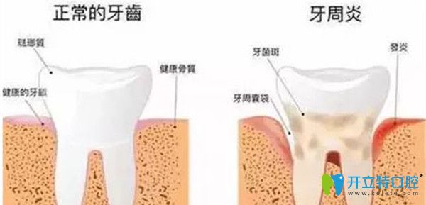 正常的牙齒狀況及牙周炎的狀況