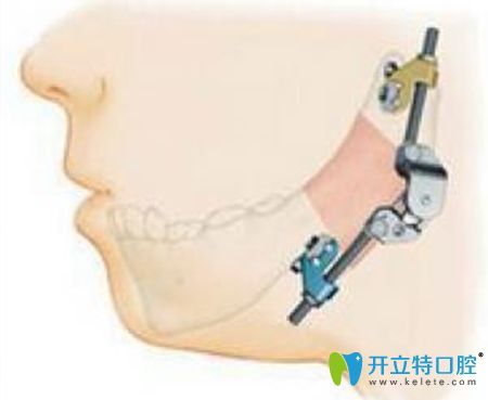 下巴錯(cuò)位別亂治!專業(yè)顳頜關(guān)節(jié)錯(cuò)位怎么復(fù)位的治療方法在此