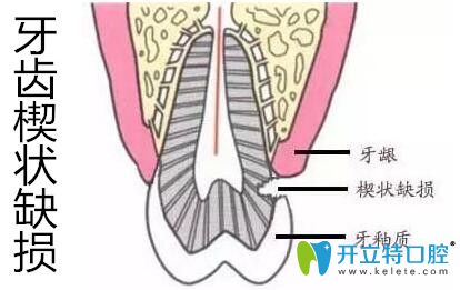 牙齒楔狀缺損千萬不要盲目補(bǔ)牙,先弄清楔狀缺損的修復(fù)方法