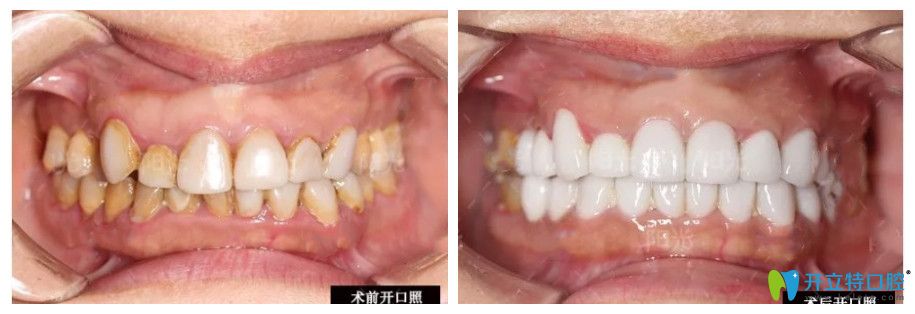 樹脂貼面換成瓷貼面修復