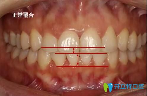 上牙包住下牙正常嗎?用一張正常的上下牙咬合圖告訴你