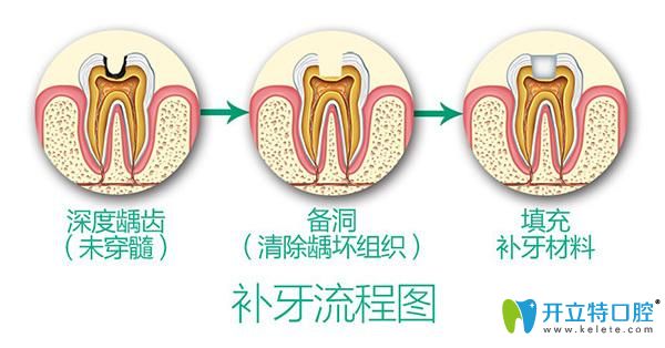 牙壞了3分之二還能補(bǔ)嗎?牙醫(yī)良心忠告,牙壞不能補(bǔ)了怎么辦