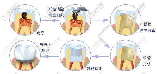 根管治療的過程示意圖