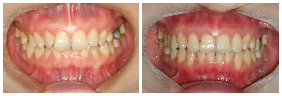 隱形牙套矯正深覆合沒(méi)效果?她做時(shí)代天使不到2年告別了嘴凸