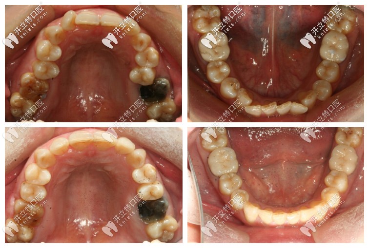 深覆合矯正前后的口內(nèi)照