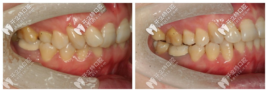 從側(cè)面照更能看出來(lái)牙齒原本的問(wèn)題