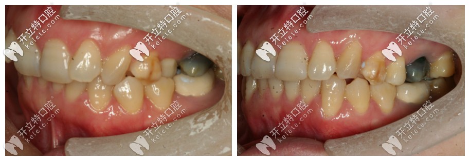 從側(cè)面照更能看出來(lái)牙齒原本的問(wèn)題