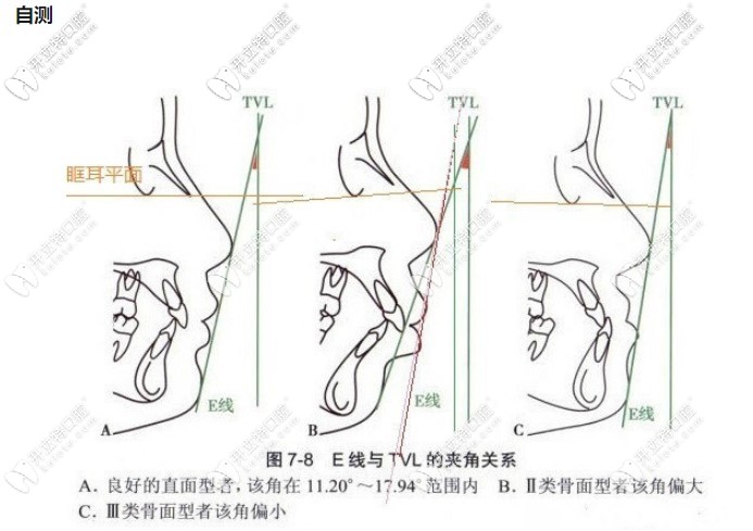 骨性齙牙和牙性齙牙怎么區(qū)分