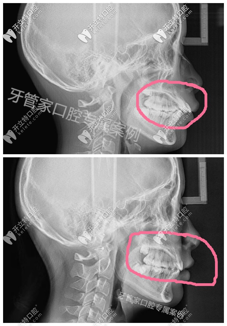 骨性齙牙帶牙套有效果，下牙套后我的骨性牙齒內(nèi)收了6毫米