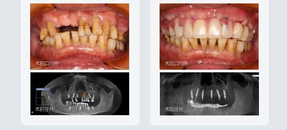 上半口無牙甭鑲牙在成都做all on 6微創(chuàng)種植牙當(dāng)天就能吃東西