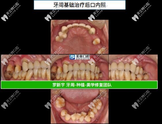 ?55歲重度牙周炎,成功在無錫美奧做了全口即刻負(fù)重種植牙