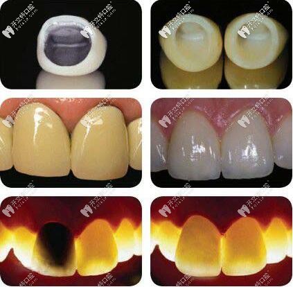 烤瓷牙和全瓷牙的圖片對(duì)比區(qū)別