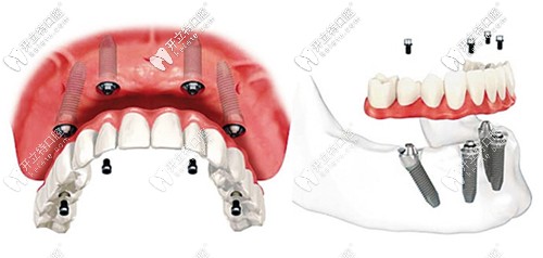 ALL-on-4種植牙技術(shù)解析