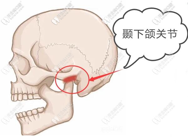 牙齒矯正的攔路虎-顳下頜關(guān)節(jié)紊亂綜合癥怎么治療