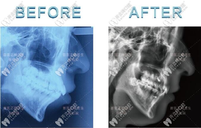 齙牙矯正前后頭顱側位片前后對比圖