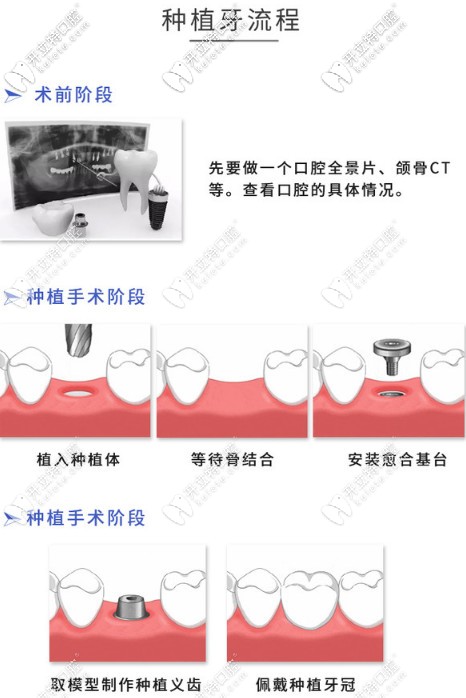 在尤旦口腔做種植牙的流程