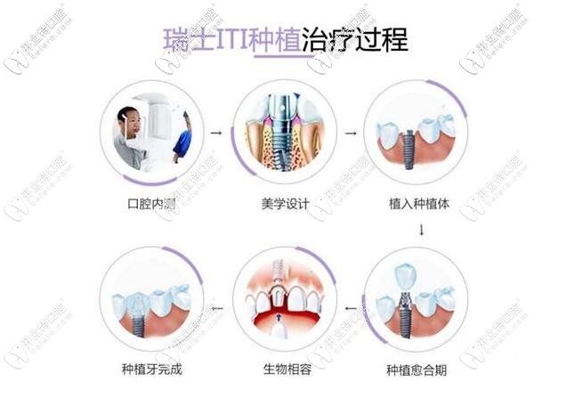 瑞士ITI種植過程