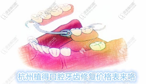 杭州植得口腔鑲牙費(fèi)用表來咯,各種活動義齒的修復(fù)價格都有