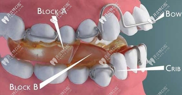 twinblock雙頜墊矯治器,對(duì)兒童下頜后縮有較大的改善