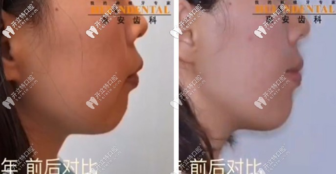 看呆！凸嘴少女在惠安齒科戴自鎖托槽矯正半年后…