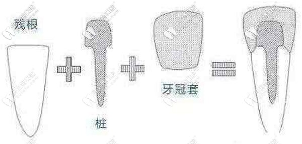 打樁補牙和鑲牙哪種效果好,大概能用多少年？