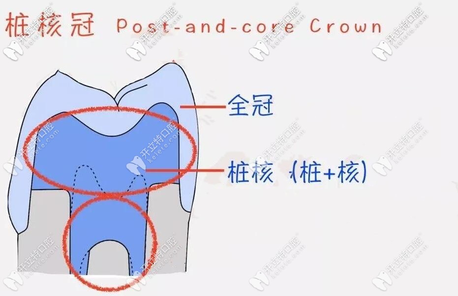 牙根剩4毫米可以做樁冠修復嗎?基本治療過程圖解你可以看看