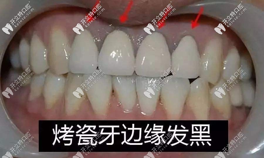 烤瓷牙的牙齦出現(xiàn)黑線怎么辦?這些修復方法你需要了解哈