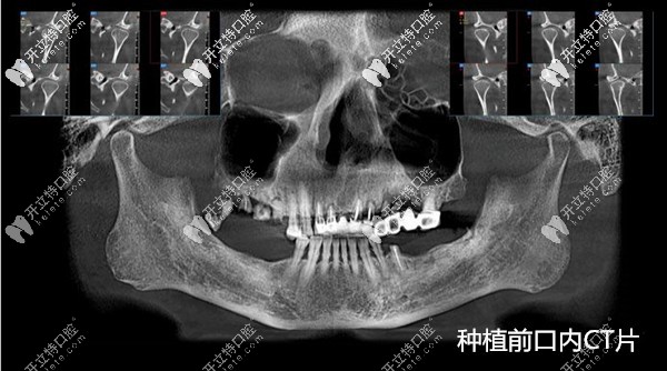 國(guó)產(chǎn)百康特種植牙質(zhì)量不輸進(jìn)口,成功運(yùn)用在全口即刻種植中