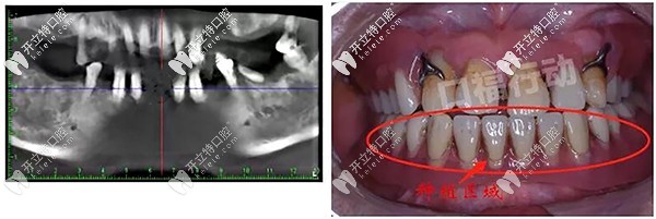 昆明美奧口腔allon4半口種植牙案例分享:牙周病殘根也能修復(fù)