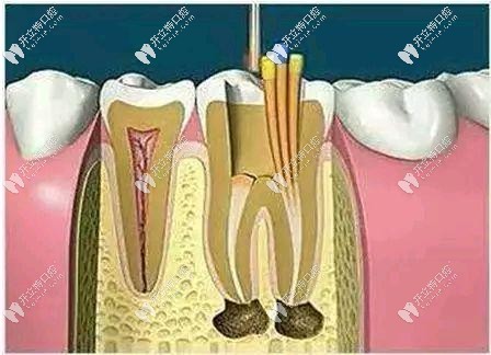 牙齒打樁用什么材料比較好,原來門牙和后牙打樁不一樣呀